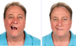 Bell's Palsy patient