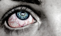 pink eye